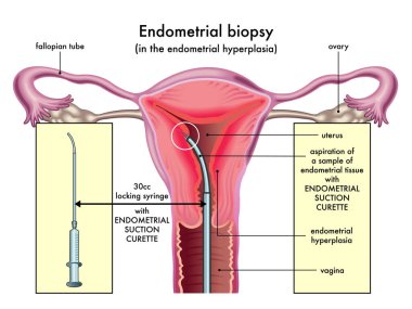 Medical illustration of the endometrial biopsy procedure with annotations clipart