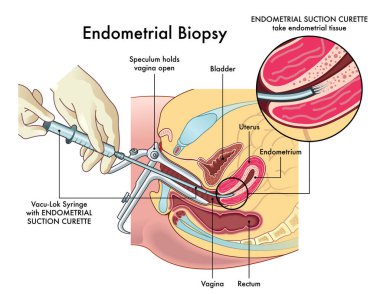 Endometriyal biyopsi prosedürünün notlarla tıbbi illüstrasyonu