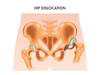 Medical illustration of the hip dislocation. clipart