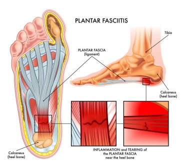 Medical illustration showing section of foot with symptoms of plantar fasciitis with two magnified details of affected points, and annotations clipart
