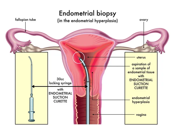 Medical Illustration Endometrial Biopsy Procedure Annotations — Stock Vector