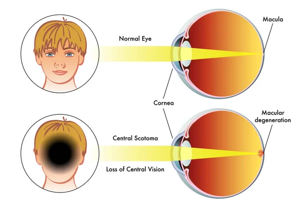 Medical Illustration Compare Human Eye Central Scotoma Normal Eye — Stock Vector