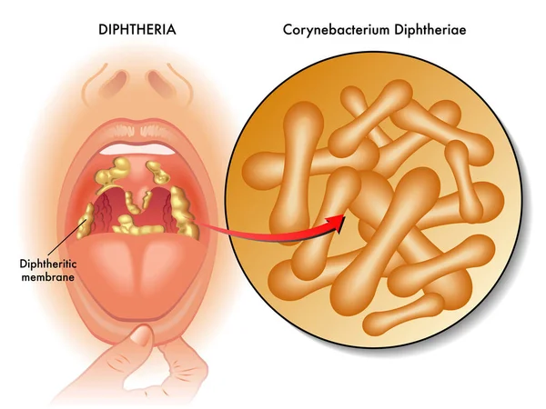 Ilustração Médica Dos Sintomas Difteria Com Anotações —  Vetores de Stock