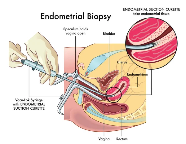 Ejemplo Médico Del Procedimiento Biopsia Endometrial Con Anotaciones — Archivo Imágenes Vectoriales