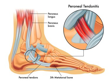 Medical illustrations of symptoms of peroneal tendonitis, with enlargement of the affected area, with annotations. clipart