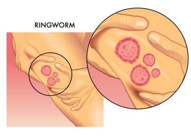 Mantar solucanından etkilenmiş, büyütülmüş bir dişi bacağının tıbbi çizimi..