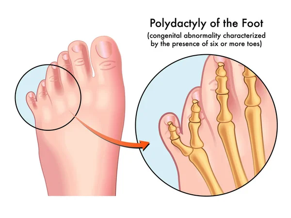 Medical Illustration Foot Afflicted Polydactyly Congenital Abnormality Characterized Presence Six — Stock Vector