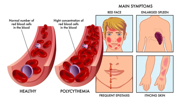 Illustrazione Medica Confronta Arteria Con Numero Normale Globuli Rossi Con — Vettoriale Stock