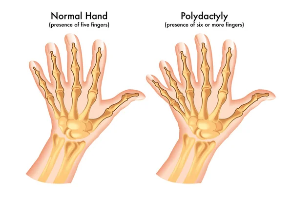 多糖類に罹患した手の医療用イラスト6本以上の指が存在することが特徴の先天性異常 — ストックベクタ