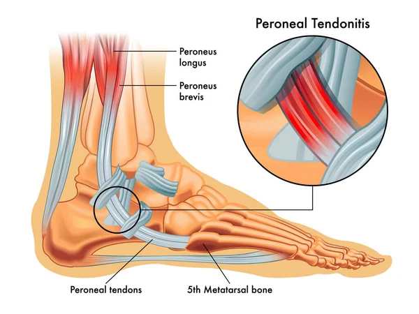 Medical Illustrations Symptoms Peroneal Tendonitis Enlargement Affected Area Annotations Stock Illustration