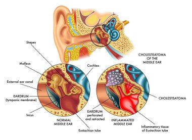 Sol kulağın iç kısmını (orta kulak) ve sağ taraftaki kolesteatomdan etkilenen iç kısmını karşılaştıran tıbbi illüstrasyon ve notlar.