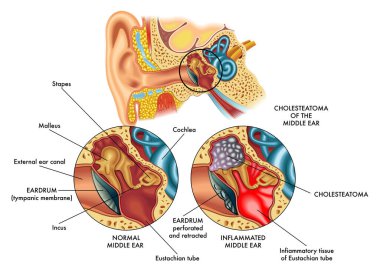 Medical illustration comparing the internal part of the ear (middle ear) on the left healthy and on the right affected by cholesteatoma, with annotations. clipart
