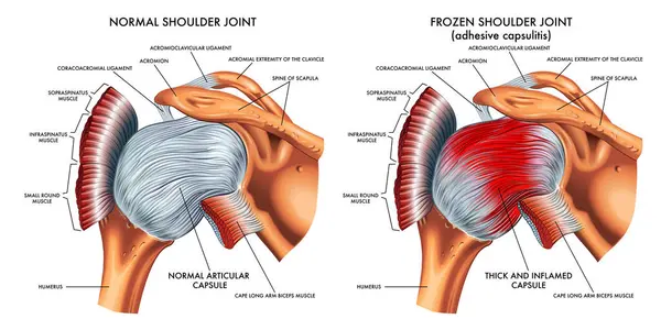 Medical Illustration Shows Difference Normal Shoulder Joint Frozen Shoulder Joint Royalty Free Stock Illustrations