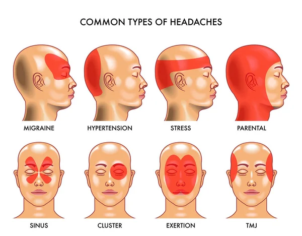 Medical Illustration Common Types Headaches Royalty Free Stock Vectors