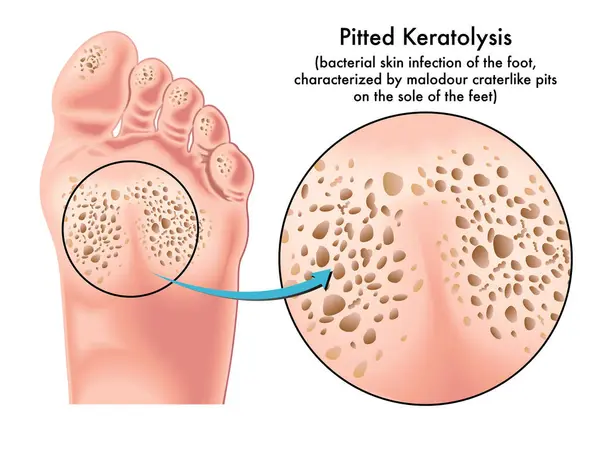 Medical Illustration Symptoms Pitted Keratolysis Bacterial Skin Infection Foot Royalty Free Stock Vectors
