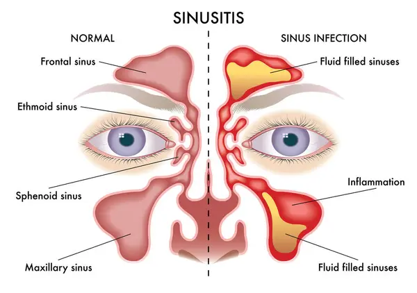 Illustrazione Medica Dei Sintomi Della Sinusite Illustrazione Stock