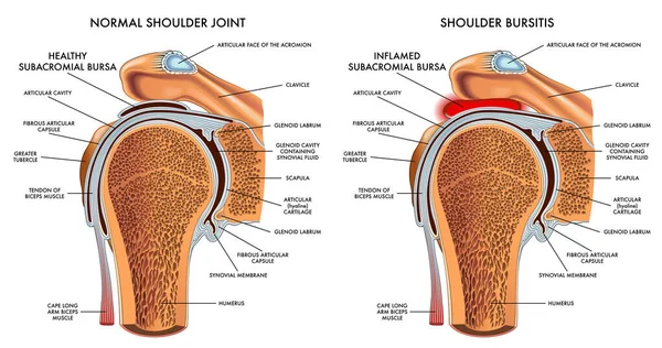 Medical Illustration Comparing Normal Shoulder Shoulder Bursitis Annotations Stock Vector