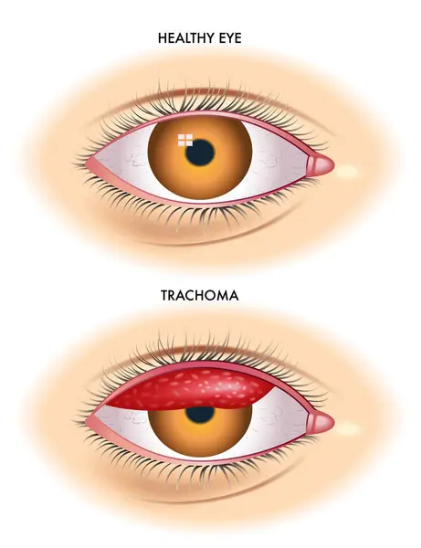 Medical Illustration Shows Comparison Normal Eye One Affected Trachoma Infectious Stock Vector