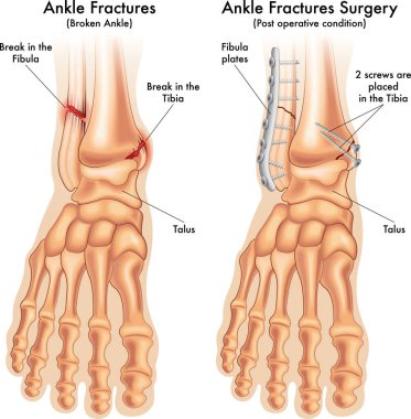 Tıbbi illüstrasyon ameliyattan önce ve sonra kırık bir ayak bileğini notlarla karşılaştırıyor..