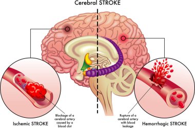 Medical illustration compares the causes of two types of cerebral stroke, an ischemic stroke, and a hemorrhagic stroke, which affect the cerebral arteries, with annotations clipart