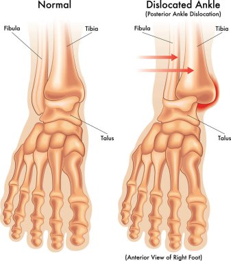Normal bir ayak bileği, çıkık bir ayak bileği ve notlarla karşılaştırılmış tıbbi çizimler..