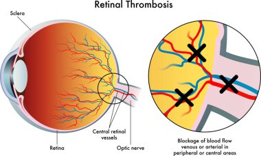 Tıbbi örnekleme retinal trombozun sonuçlarını gösteriyor.