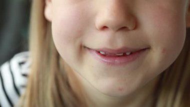 A child demonstrates the loss of a baby tooth. The transformation of a young childs happy expression into a toothless smile.