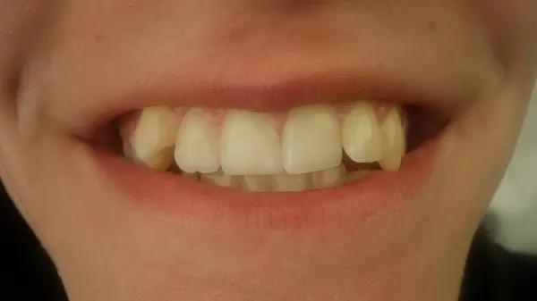 Nuoren Miehen Hampaat Hampaat Ennen Hammasraudat Tarvitsevat Oikomishoidon Hammaslääkäripalvelut Makroruisku — kuvapankkivalokuva