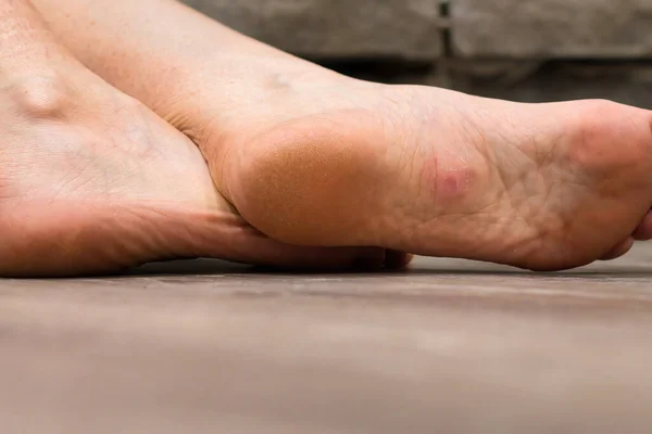 Pink skin on a wart on the sole of a foot on a wood floor.