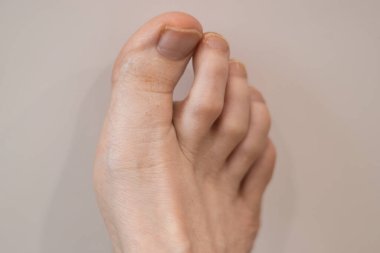 Büyük bir ayak parmağındaki tırnak, beyaz bir arkaplanda..