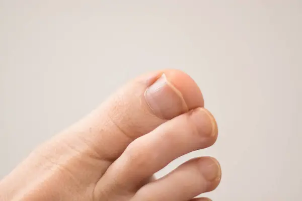Big toe on a foot next with jagged nail against a white background.