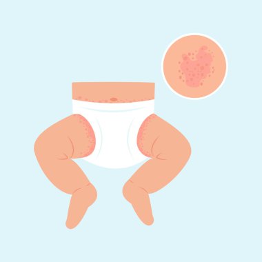 Bebek bezi döküntüsü, deri döküntüsü, alerji. Çocukların cilt kızarıklığı. Dermatolojik sorunlar. Vektör illüstrasyonu