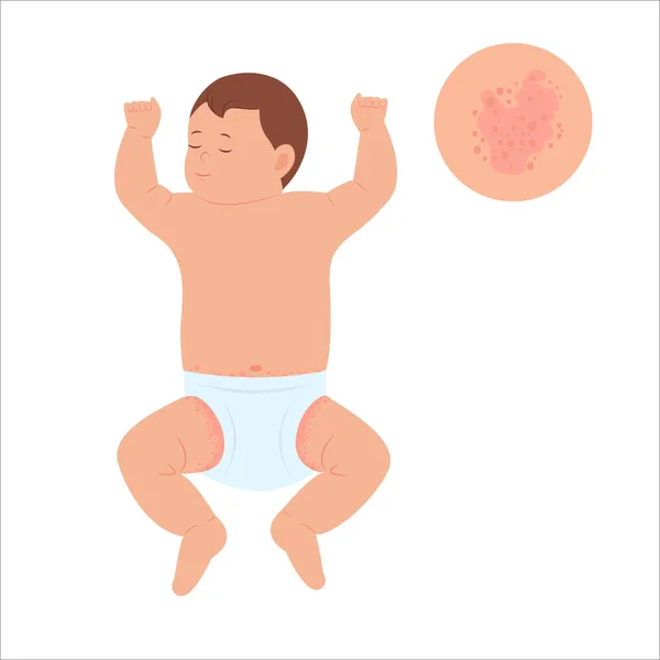 Bebê Com Erupção Fralda Erupção Cutânea Alergia Vermelhidão Pele Crianças — Vetor de Stock