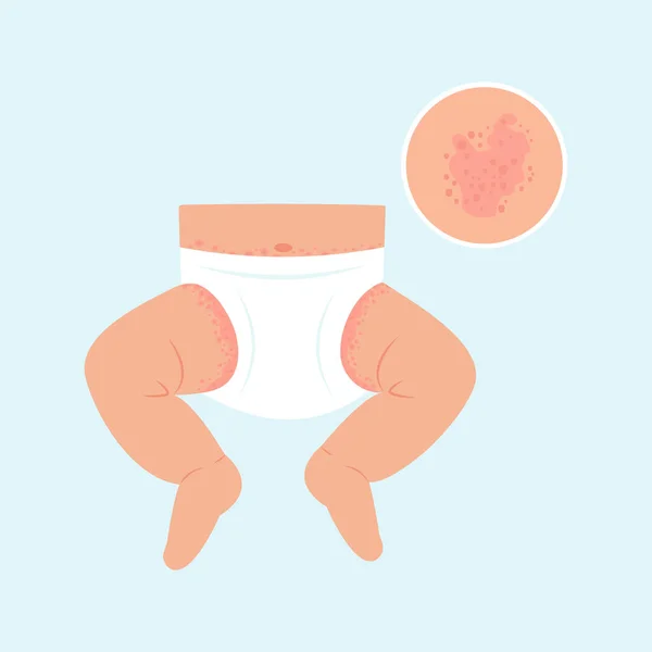 Baby Diaper Rash Skin Rash Allergy Redness Skin Children Dermatological — Stock Vector