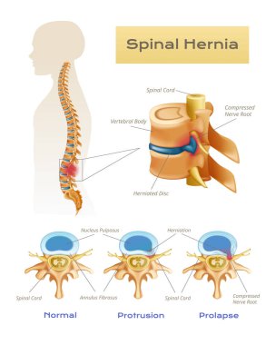 Omurilik anatomisi bilgi grafikleri. Metin başlıkları ve işaretçi vektör illüstrasyonlu omurilik fıtığının bilimsel görüntüsü.