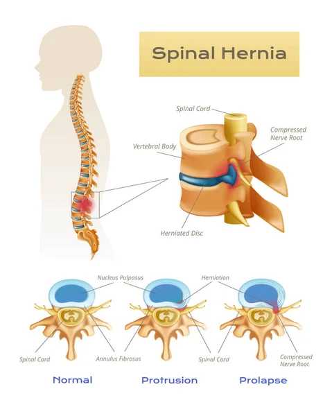 Vertebrae Spinal Cord Anatomy Infographics Scientific View Spinal Hernia Text — Stock Vector