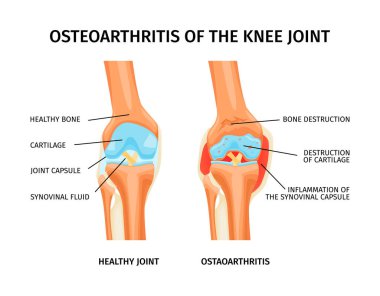 Sağlıklı diz anatomisi ile gerçekçi bilgi grafikleri ve etiketli parça vektör çizimi ile eklem eklem osteoartriti