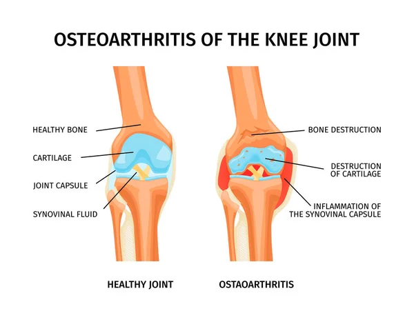 健康な膝の解剖学とラベル付き部品との関節の変形性関節症と現実的なインフォグラフィックベクトル図 — ストックベクタ