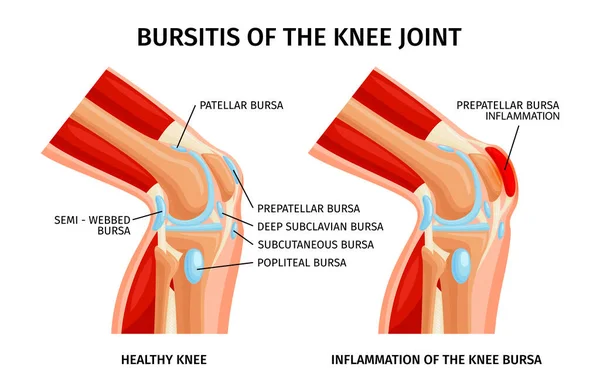 Bursitis Knee Bursa Realistic Infographics Anatomy Healthy Unhealthy Joints Vector — Stock Vector