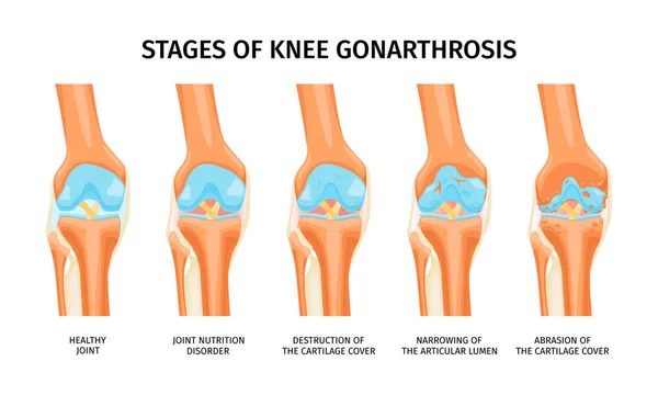 健康な関節から軟骨カバーのイラストの摩耗に膝関節症の段階を提示現実的なインフォグラフィック — ストックベクタ