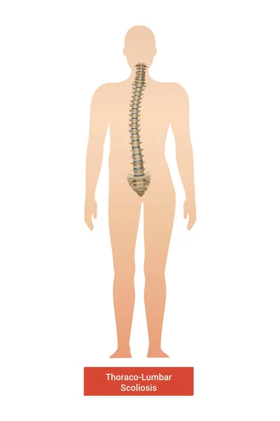 Spinal Curvature Scoliosis Composition Anatomic View Human Body Silhouette Spine — Stok Vektör