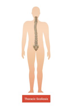 Spinal curvature scoliosis composition with anatomic view of human body silhouette with spine and text vector illustration