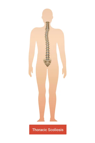 Spinal Curvature Scoliosis Composition Anatomic View Human Body Silhouette Spine — Vettoriale Stock