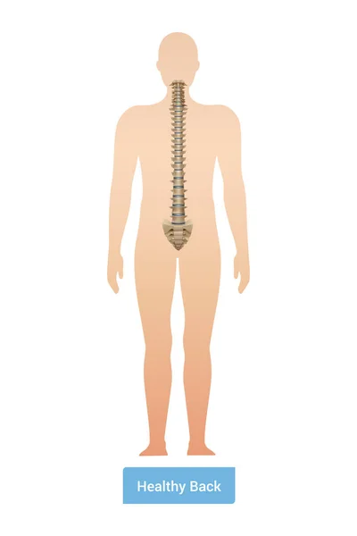 Spinal Curvature Scoliosis Composition Anatomic View Human Body Silhouette Spine — 图库矢量图片