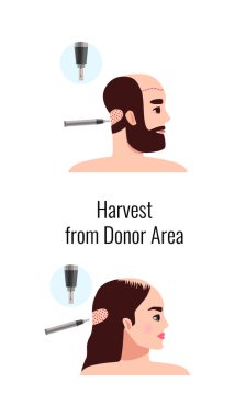 Alopecia hair transplantation composition with infographic image of hair restoration procedures with text vector illustration