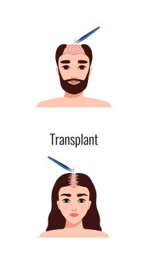 Alopecia hair transplantation composition with infographic image of hair restoration procedures with text vector illustration
