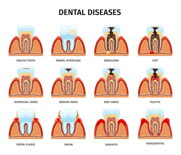 Проблеми Анатомією Зубів Встановлені Ізольованими Композиціями Зуба Щелепі Здорові Пошкоджені — стоковий вектор