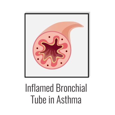 Asthma composition with isolated medical infographic image of chronic disease on blank background vector illustration