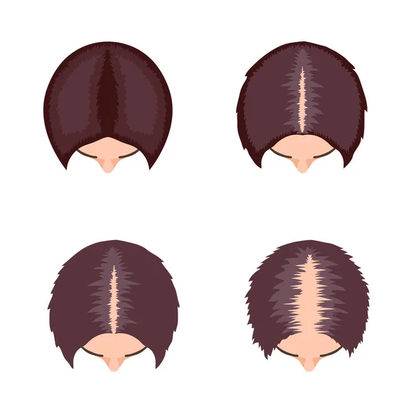 Alopecia Haj Transzplantáció Összetétele Infografikus Kép Haj Helyreállítási Eljárások Vektor — Stock Vector