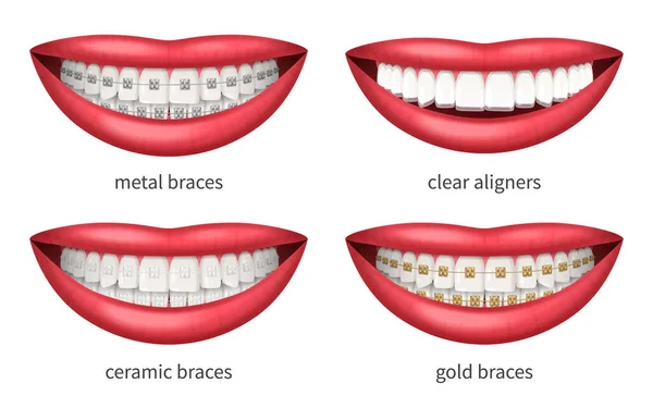 Zubní Rovnátka Ikony Nastavit Realistickými Lidskými Rty Izolované Vektorové Ilustrace — Stockový vektor